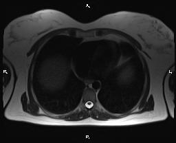 File:Bilateral adrenal myelolipoma (Radiopaedia 63058-71537 Axial T2 3).jpg