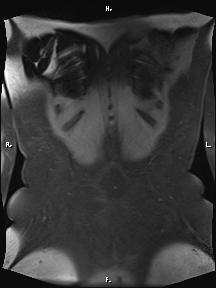 Bilateral adrenal myelolipoma (Radiopaedia 63058-71537 Coronal T1 fat sat 8).jpg