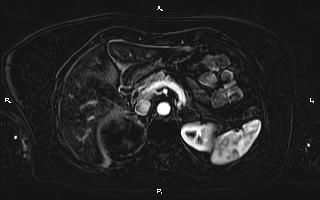 Bilateral adrenal myelolipoma (Radiopaedia 63058-71537 I 34).jpg