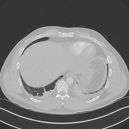 Bilateral atelectasis (Radiopaedia 48666-53675 Axial lung window 91).jpg