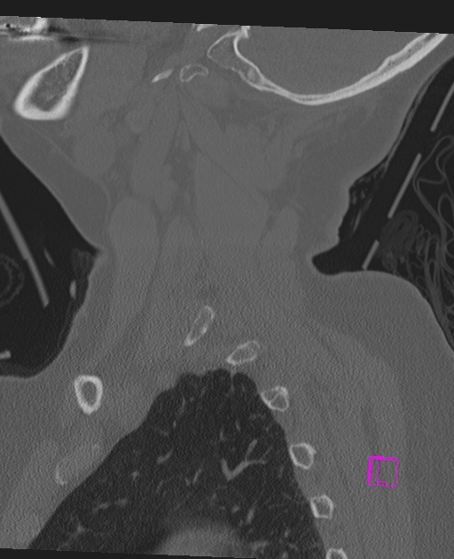 Bilateral atlanto-occipital assimilation (Radiopaedia 28350-28603 Sagittal bone window 16).jpg