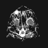 Bilateral basal ganglia and thalamic T1 hyperintensities (Radiopaedia 19764-19802 Axial DWI 41).jpg