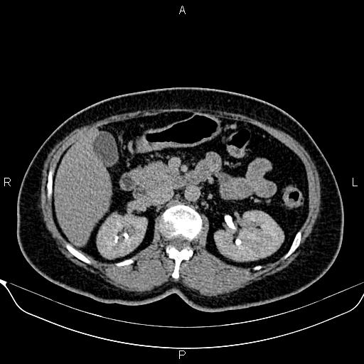 File:Bilateral benign adrenal adenomas (Radiopaedia 86912-103124 Axial C+ delayed 52).jpg