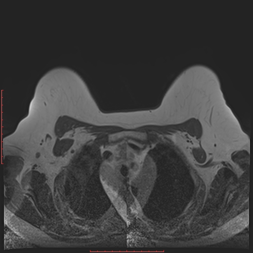 File:Bilateral breast implant rupture (Radiopaedia 24761-25027 T1 6).jpg