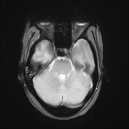 File:Bilateral carotid body tumors and right jugular paraganglioma (Radiopaedia 20024-20060 Axial 83).jpg
