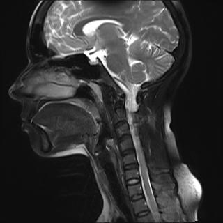 File:Bilateral carotid body tumors and right jugular paraganglioma (Radiopaedia 20024-20060 Sagittal 29).jpg