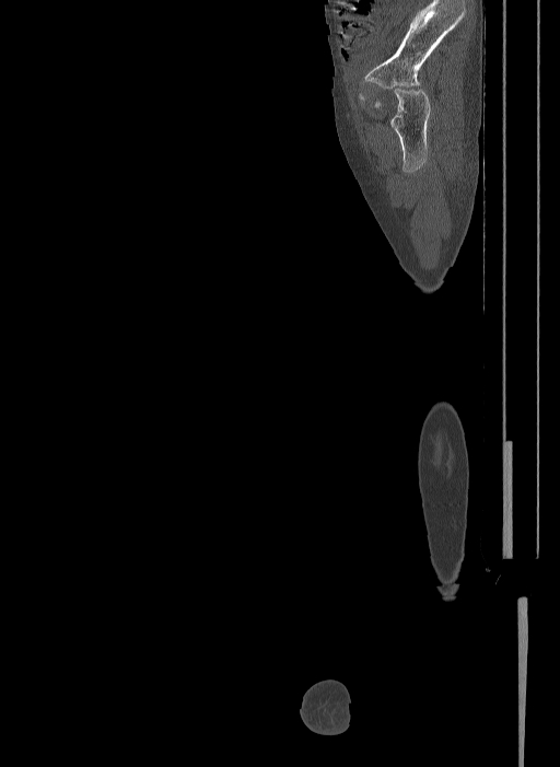 Bilateral fibular hemimelia type II (Radiopaedia 69581-79491 Sagittal bone window 35).jpg