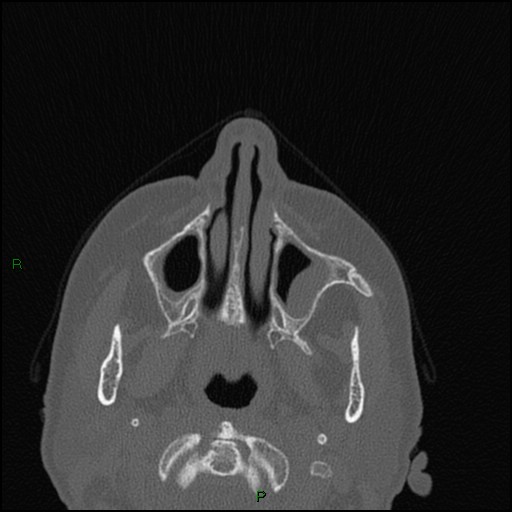 Bilateral frontal mucoceles (Radiopaedia 82352-96454 Axial bone window 219).jpg