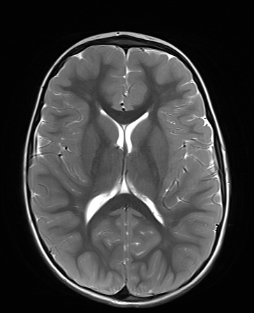 File:Bilateral mesial temporal polymicrogyria (Radiopaedia 76456-88181 Axial T2 14).jpg