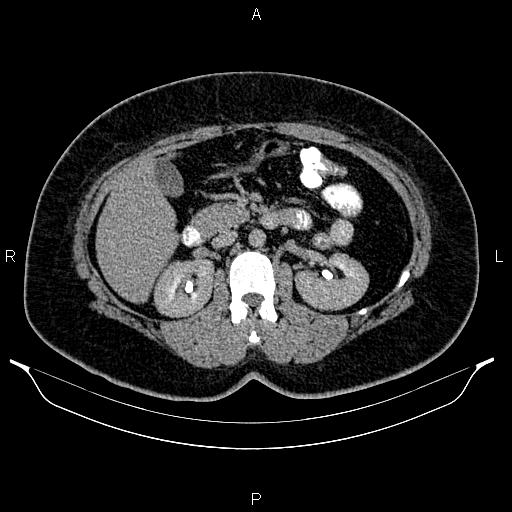 Bilateral ovarian dermoid cysts (Radiopaedia 85785-101603 Axial C+ delayed 26).jpg