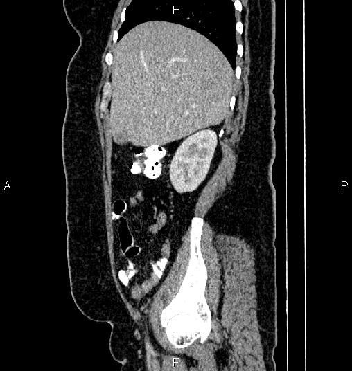 File:Bilateral ovarian dermoid cysts (Radiopaedia 85785-101603 D 19).jpg