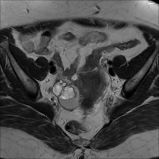 File:Bilateral ovarian dermoid cysts (Radiopaedia 90152-107338 Axial T2 10).jpg