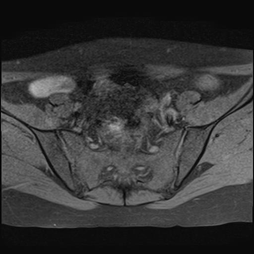 File:Bilateral ovarian endometriomas (Radiopaedia 87085-103347 Axial T1 fat sat 5).jpg