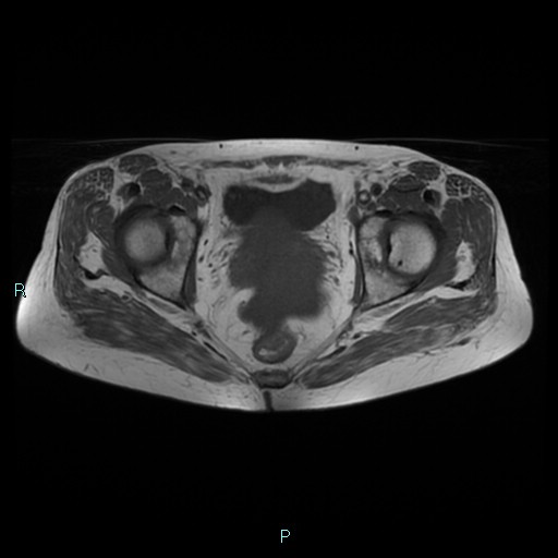 File:Bilateral ovarian fibroma (Radiopaedia 44568-48293 Axial T1 19).jpg