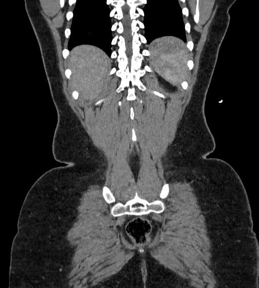 Bilateral ovarian mature cystic teratomas (Radiopaedia 79373-92457 B 97).jpg
