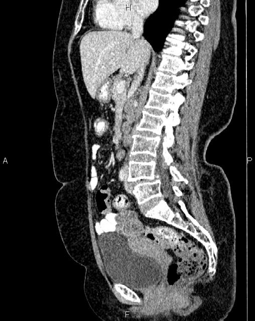 Bilateral ovarian serous cystadenocarcinoma (Radiopaedia 86062-101989 E 39).jpg
