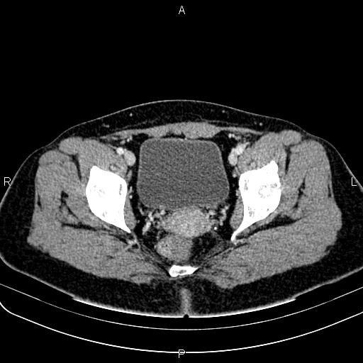 File:Bilateral ovarian teratoma (Radiopaedia 83131-97503 Axial With contrast 60).jpg