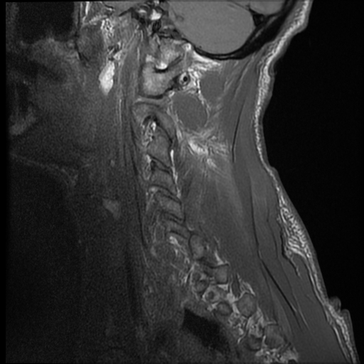 File:Bilateral perched facets with cord injury (Radiopaedia 45587-49714 Sagittal T1 16).jpg