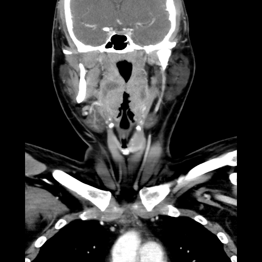 Bilateral peritonsillar abscess (Radiopaedia 85065-100610 Coronal 35).jpg