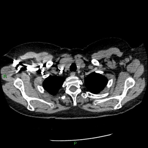 File:Bilateral pulmonary emboli (Radiopaedia 32700-33669 Axial C+ CTPA 9).jpg