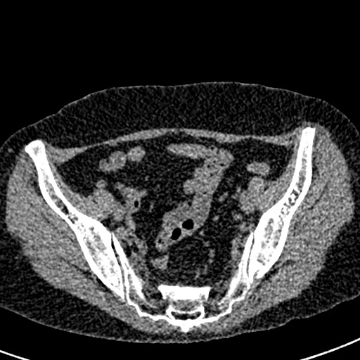 Bilateral staghorn calculi (Radiopaedia 59475-66842 Axial non-contrast 65).jpg