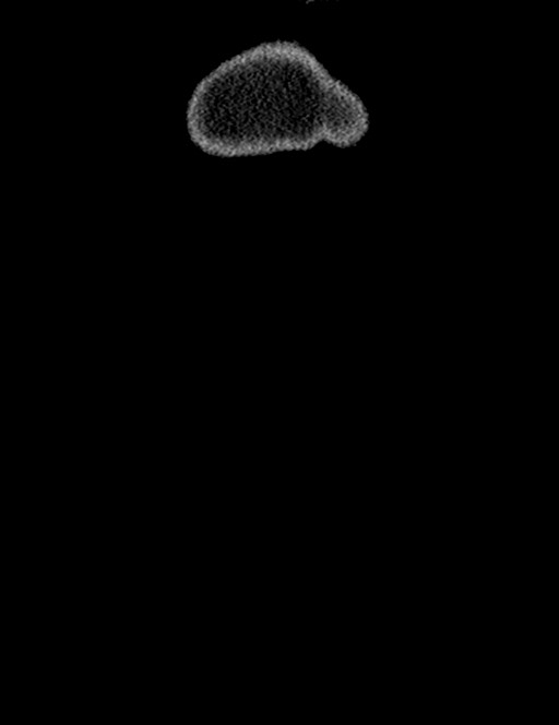 Bilateral staghorn calculi (Radiopaedia 59475-66842 Coronal non-contrast 19).jpg