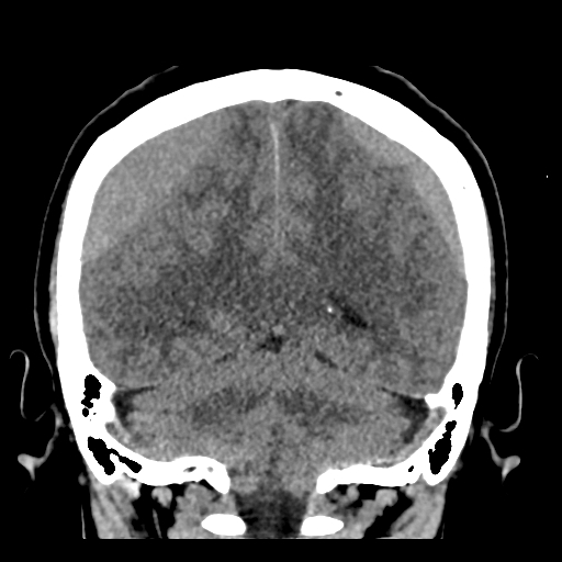 Bilateral subacute subdural hematoma (Radiopaedia 69240-79018 Coronal non-contrast 40).jpg