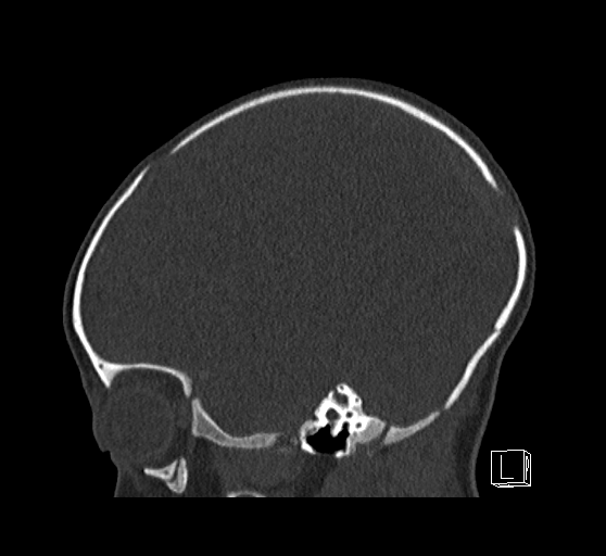 Bilateral subdural hemorrhage and parietal skull fracture (Radiopaedia 26058-26192 Sagittal bone window 26).png