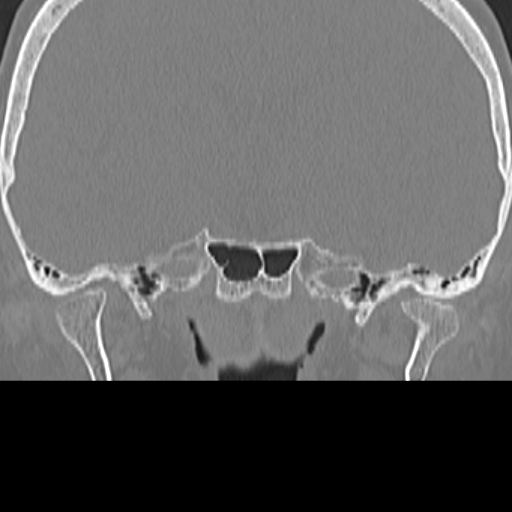 File:Bilateral tympanoplasty (Radiopaedia 16947-16664 Coronal bone window 1).jpg