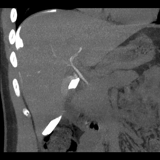 File:Bile leak from liver traumatic laceration (Radiopaedia 63463-72077 Coronal Biliscopin 14).jpg