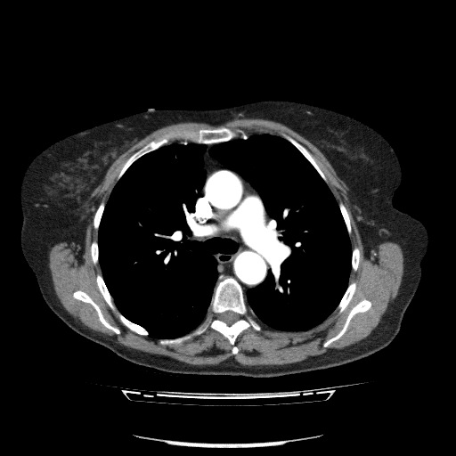 Bladder tumor detected on trauma CT (Radiopaedia 51809-57609 A 42).jpg