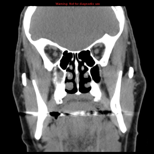 File:Blowout fracture with inferior rectus entrapment (Radiopaedia 12418-12673 Coronal non-contrast 17).jpg
