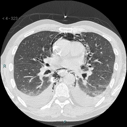 Boerhaave syndrome (Radiopaedia 27683-27897 lung window 43).jpg