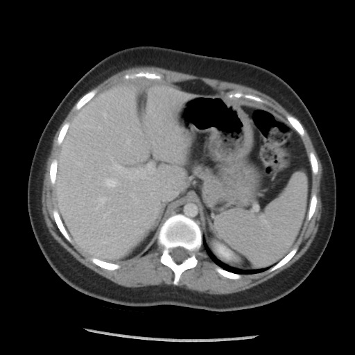 File:Borderline mucinous tumor (ovary) (Radiopaedia 78228-90808 A 72).jpg