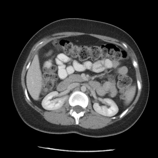 File:Borderline mucinous tumor (ovary) (Radiopaedia 78228-90808 A 83).jpg
