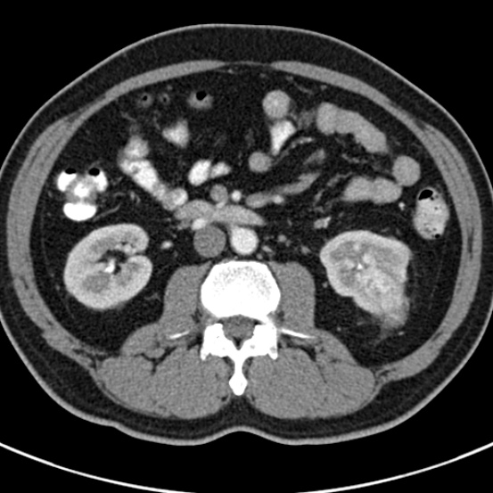 File:Bosniak cyst - type IV (Radiopaedia 23525-23627 renal cortical phase 34).jpg