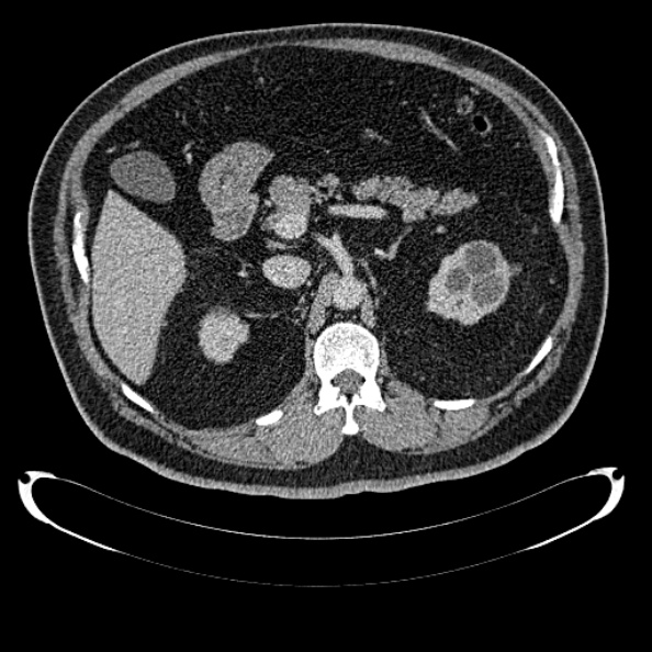 Bosniak renal cyst - type IV (Radiopaedia 24244-24518 C 109).jpg
