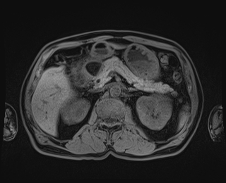 Bouveret syndrome (Radiopaedia 61017-68856 Axial T1 fat sat 34).jpg
