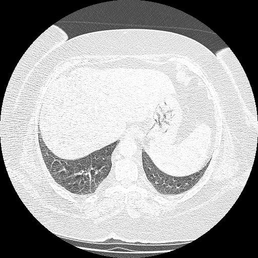 Bovine aortic arch - right internal mammary vein drains into the superior vena cava (Radiopaedia 63296-71875 Axial lung window 142).jpg