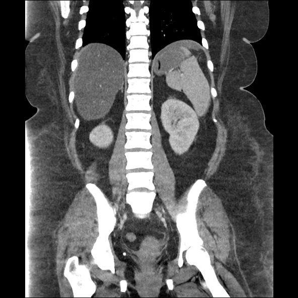 File:Bowel and splenic infarcts in acute lymphocytic leukemia (Radiopaedia 61055-68915 B 42).jpg