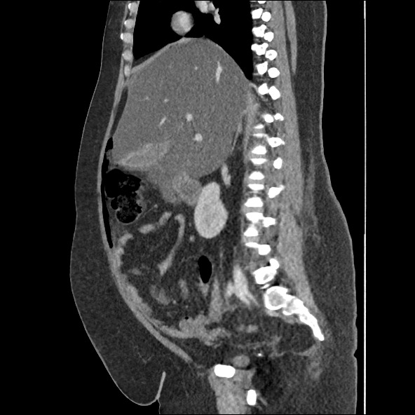 Bowel and splenic infarcts in acute lymphocytic leukemia (Radiopaedia 61055-68915 C 41).jpg