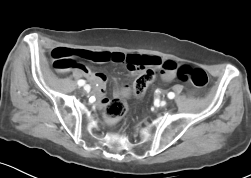 File:Bowel ischemia (Radiopaedia 58273-65382 A 49).png