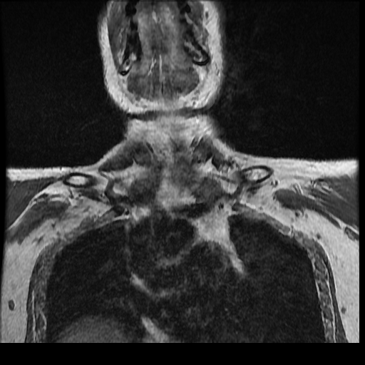 File:Brachial plexus neurofibroma (Radiopaedia 28030-28291 Coronal T1 15).png