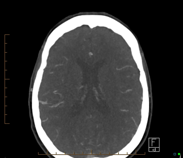 Brachiocephalic trunk stenosis (Radiopaedia 87242-103519 A 28).jpg