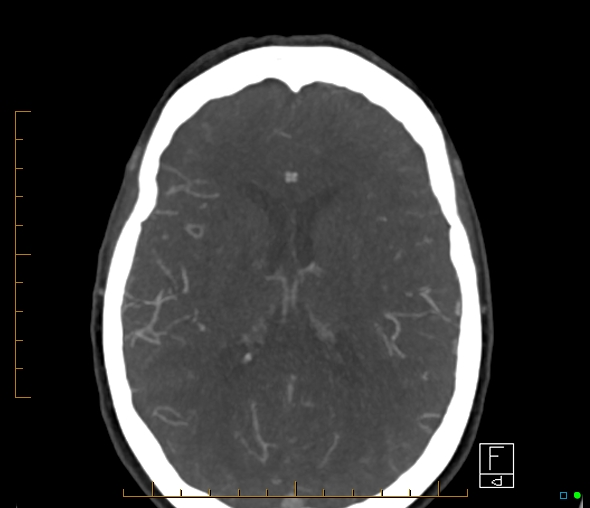 Brachiocephalic trunk stenosis (Radiopaedia 87242-103519 A 30).jpg