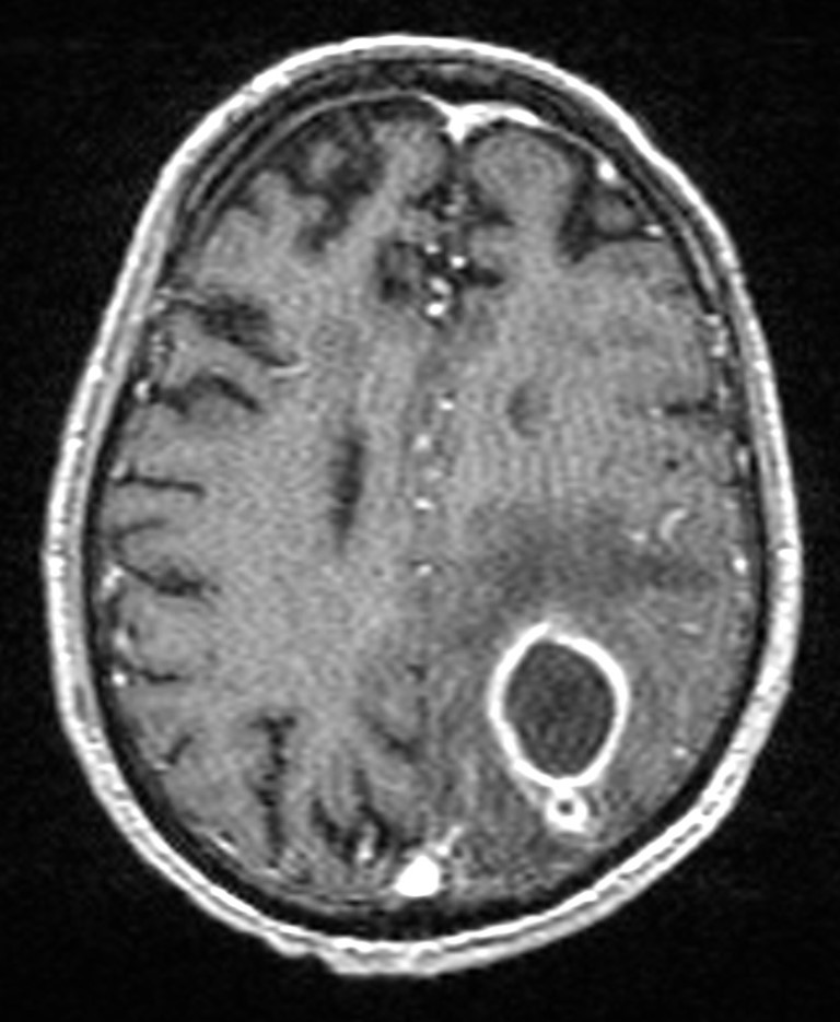 Brain abscess with dual rim sign (Radiopaedia 87566-103938 Axial T1 C+ 112).jpg