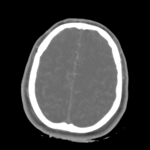 Brain contusions, internal carotid artery dissection and base of skull fracture (Radiopaedia 34089-35339 D 13).png