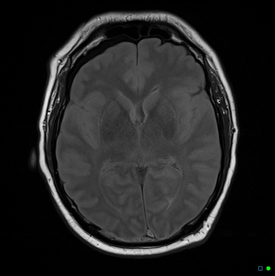 File:Brain death on MRI and CT angiography (Radiopaedia 42560-45689 Axial FLAIR 9).jpg