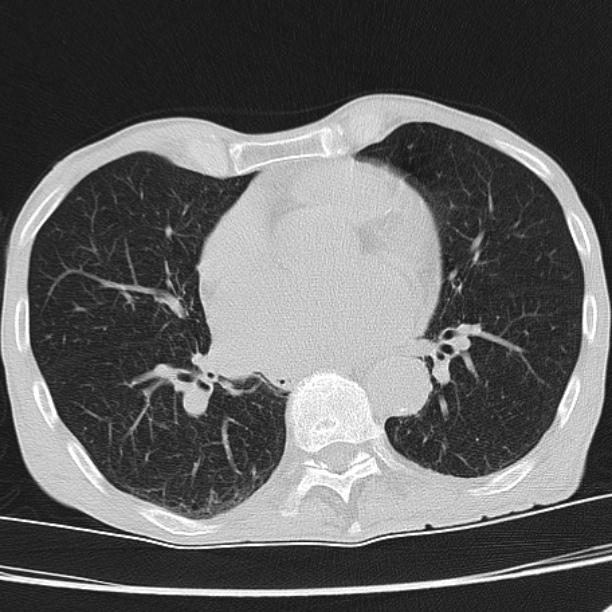 Brain metastases from lung cancer (Radiopaedia 27849-28093 Axial lung window 40).jpg