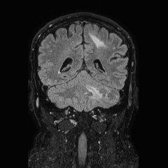 Brain metastases from lung cancer (Radiopaedia 83839-99028 Coronal FLAIR 56).jpg
